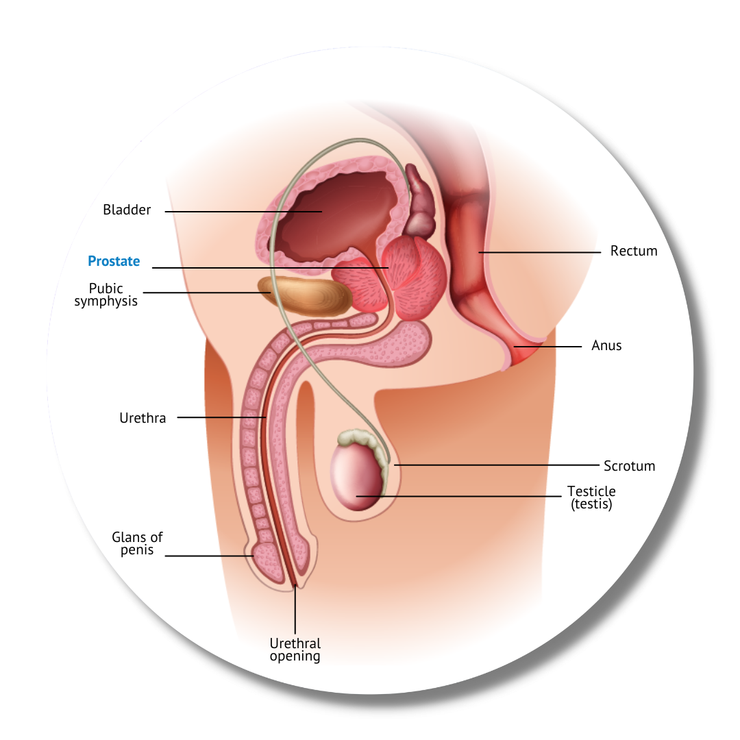 Prostate Cancer Graphic